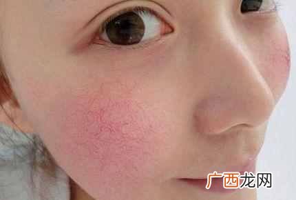 脸上红血丝怎么办,几个偏方教你快速去除!