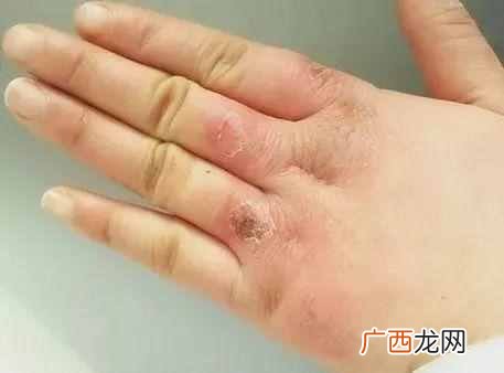 冻疮怎么治，教你根治冻疮的好办法！