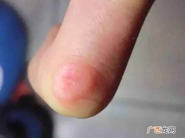 冻疮怎么治，教你根治冻疮的好办法！