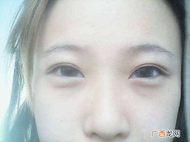 怎么去除眼袋，教你几个步骤解决！