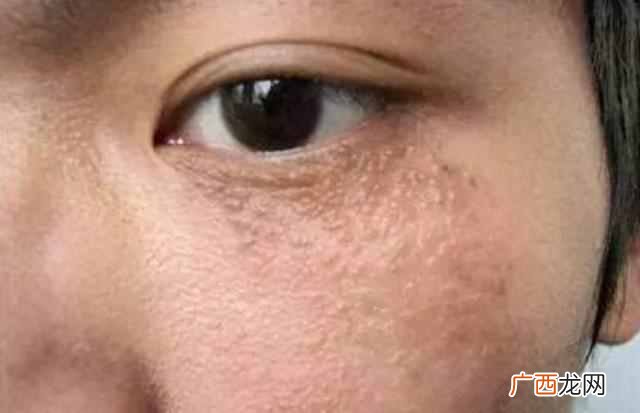 脂肪粒怎么去掉，一个妙招就可以解决！