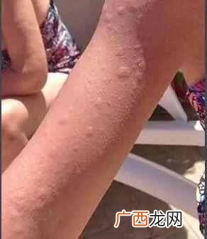 冷空气过敏怎么办，一招就可以预防！