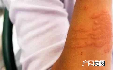 冷空气过敏怎么办，一招就可以预防！