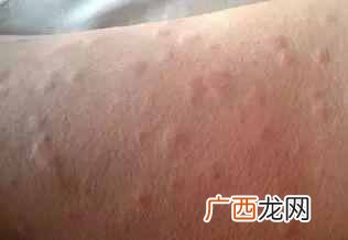 冷空气过敏怎么办，一招就可以预防！