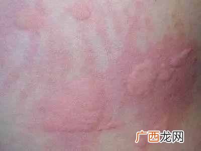 冷空气过敏怎么办，一招就可以预防！