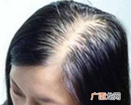 掉发严重怎么办，脱发的原因有哪些！