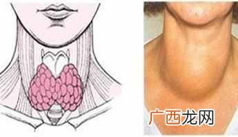 甲状腺炎怎么治疗，甲状腺炎有哪些症状！