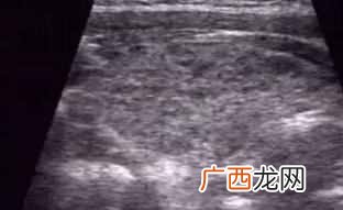 甲状腺炎怎么治疗，甲状腺炎有哪些症状！