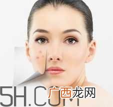 湿热型痤疮是什么?怎么调理湿热型痤疮?