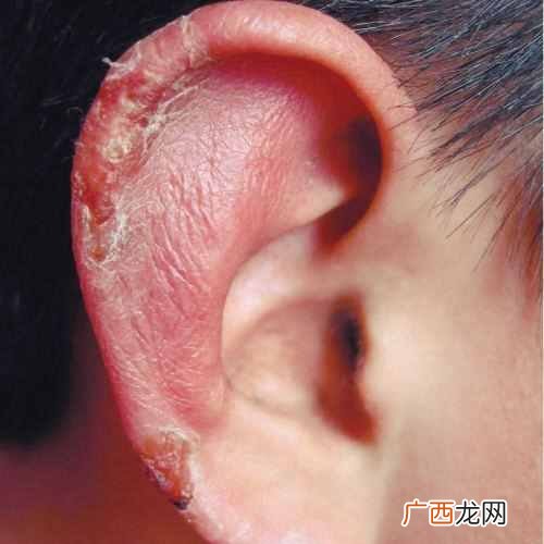 冻疮怎么根治，教你几个秘方根治冻疮！