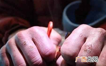 冻疮怎么根治，教你几个秘方根治冻疮！