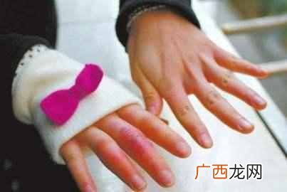 冻疮怎么根治，教你几个秘方根治冻疮！