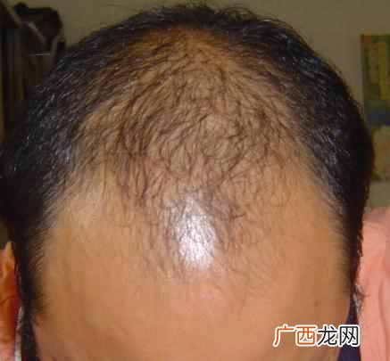 头顶头发稀少怎么办，生发秘方分享！