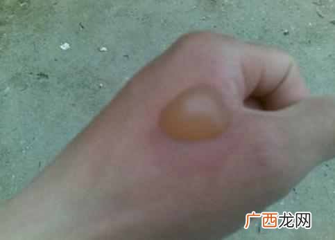 烫伤怎么办,快速处理不留疤!