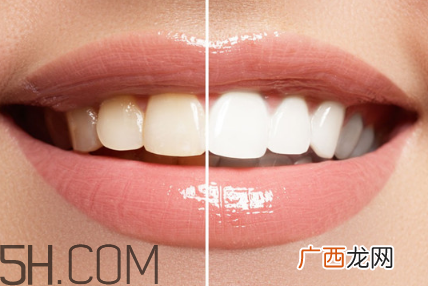 牙齿内侧的黄垢怎么去除？每天刷几次牙齿最合适？