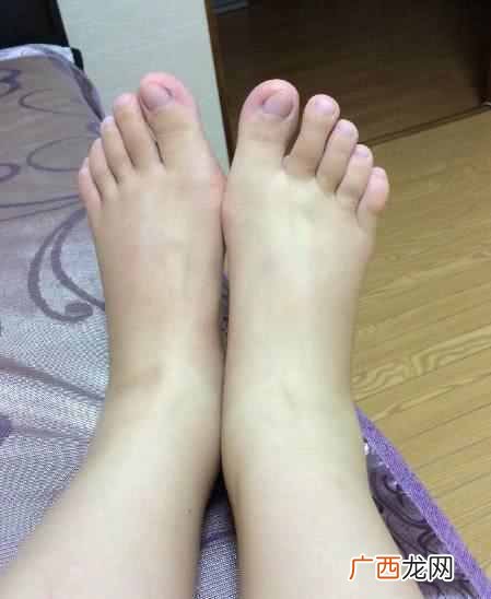 湿气重怎么调理,湿气重是什么原因!