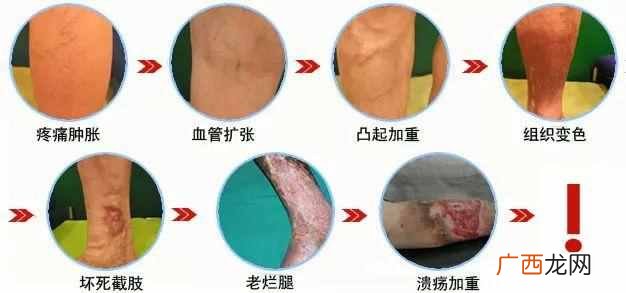 静脉曲张怎么治疗最好，教你几个神奇疗法！