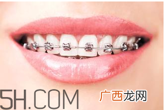 补牙需要带牙套吗？补牙后要装牙套多少钱？