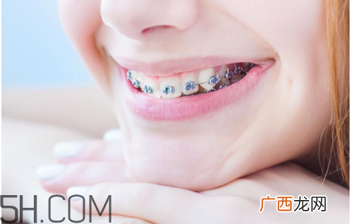 牙套的作用牙套要戴多久