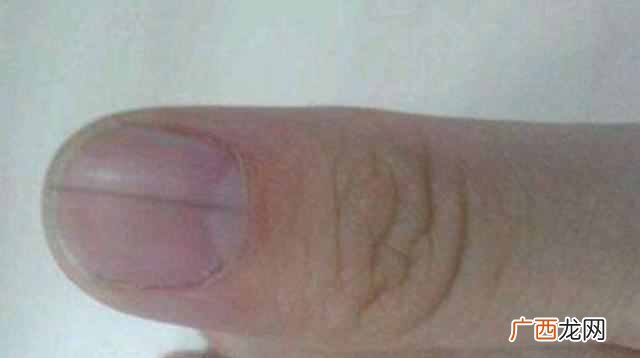手指指甲上有竖纹是怎么回事（主要是这个原因