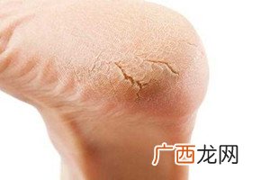 冬天裂脚怎么办?5招缓解裂脚