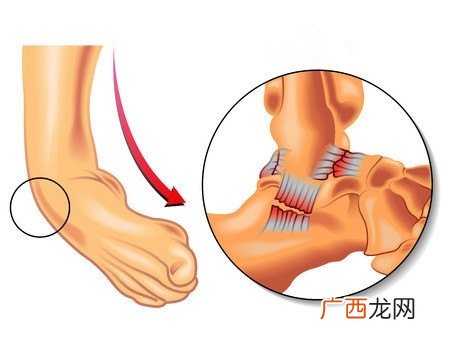 崴脚了怎么办？缓解疼痛6大招