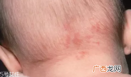 痣什么情况下会转变为瘤?点痣不可取