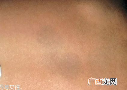 痣什么情况下会转变为瘤?点痣不可取