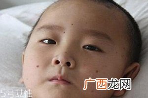 痣什么情况下会转变为瘤?点痣不可取