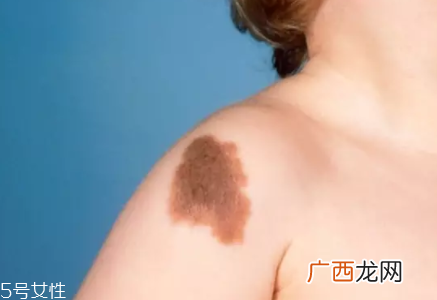 痣什么情况下会转变为瘤?点痣不可取