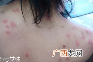 螨虫有哪些危害?严重时肌肤糜烂