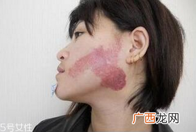 胎记怎么去除？胎记有遗传的可能
