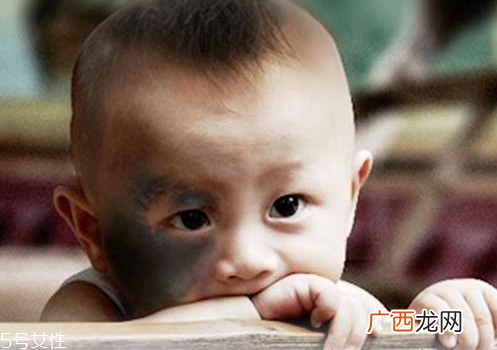 胎记怎么去除？胎记有遗传的可能
