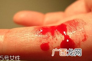血友病的主要表现有哪些？出血是最明显的特征