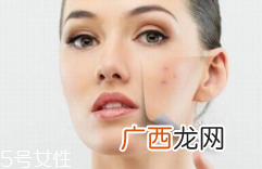 痘印多久能自行消失?多数人一年内消失