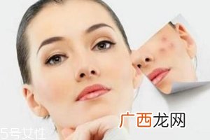痘印多久能自行消失?多数人一年内消失