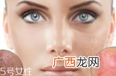 痘印多久能自行消失?多数人一年内消失