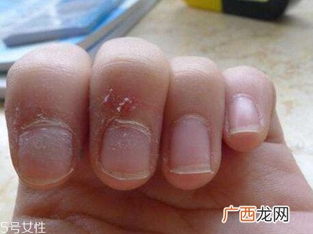 手指起倒刺是什么原因肌肤太干燥引起