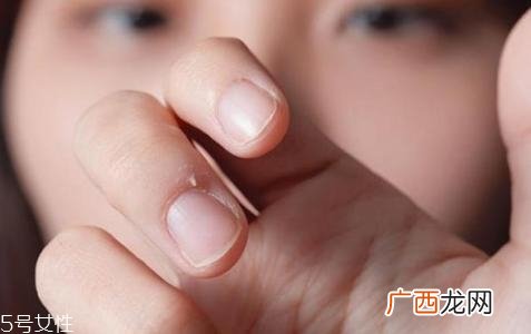 手指起倒刺是什么原因肌肤太干燥引起