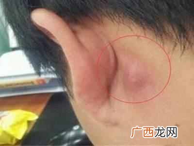 耳垂里有硬块是怎么回事，千万不能大意的症状