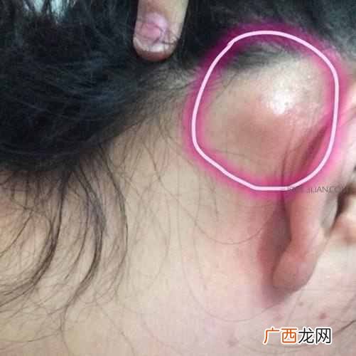 耳垂里有硬块是怎么回事，千万不能大意的症状