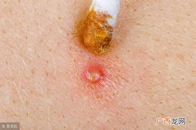 毛囊炎传染吗，细菌和真菌哪个更容易感染！