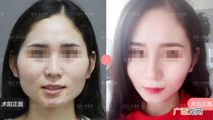 磨骨下颌角，韩国爱豆出道前必做下颌角磨骨手术