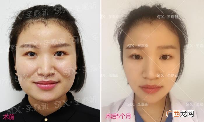 磨骨下颌角，韩国爱豆出道前必做下颌角磨骨手术