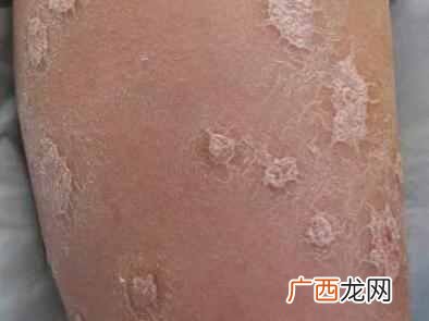 牛皮癣如何根治，怎么缓解牛皮癣症状！