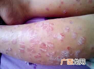 牛皮癣如何根治，怎么缓解牛皮癣症状！