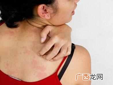 牛皮癣如何根治，怎么缓解牛皮癣症状！