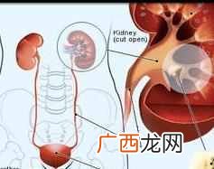 尿结石吃什么好，有哪些禁忌是不能吃的！