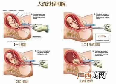 什么是无痛人流，无痛人流有哪些危害！