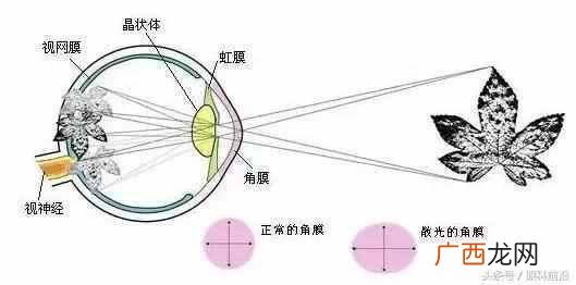 散光可以治好吗，散光是什么原因！